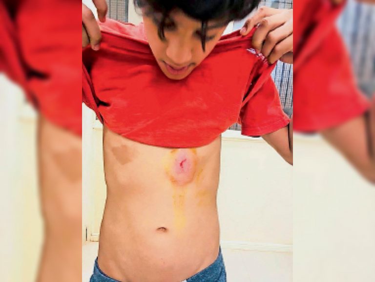 ग्वालियर में कुत्तों ने कांग्रेस नेत्री के बेटे का पेट और हाथ नोंचा, महिलाओं ने बचाया