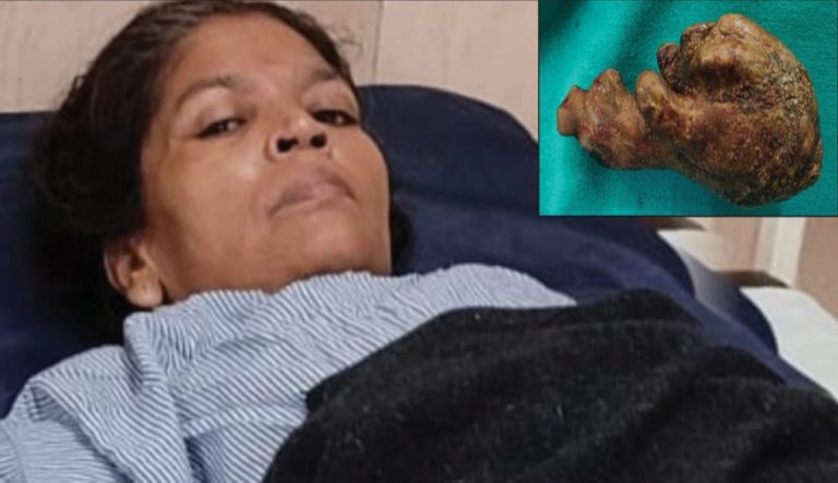 डॉक्टरों ने महिला का ऑपरेशन कर पेट से निकाला सबसे बड़ा स्टोन