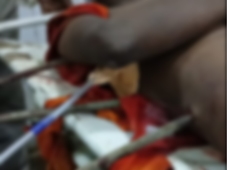 भयानक हादसा: मजदूर के शरीर में घुसे तीन सरिये, ऐसे बची जान!