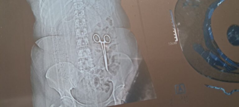 महिला के पेट में निकली कैंची, दर्द होने पर कराया CT Scan