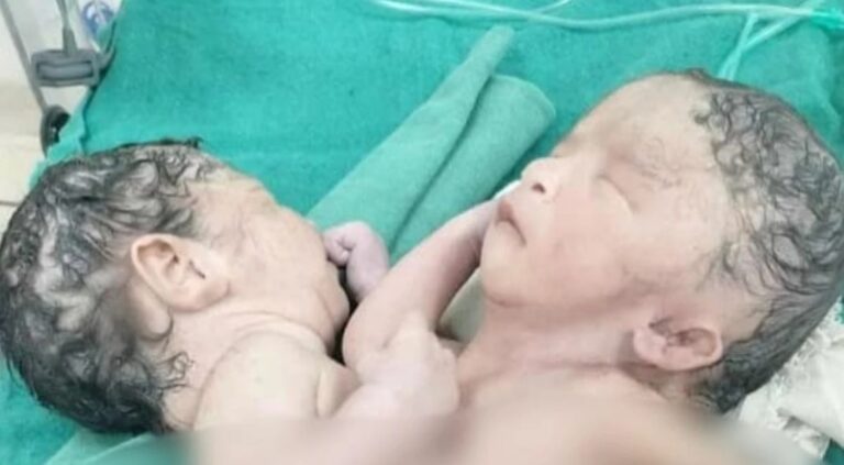 जुड़वा बच्चों का हुआ जन्म, लोग देखकर हुए हैरान
