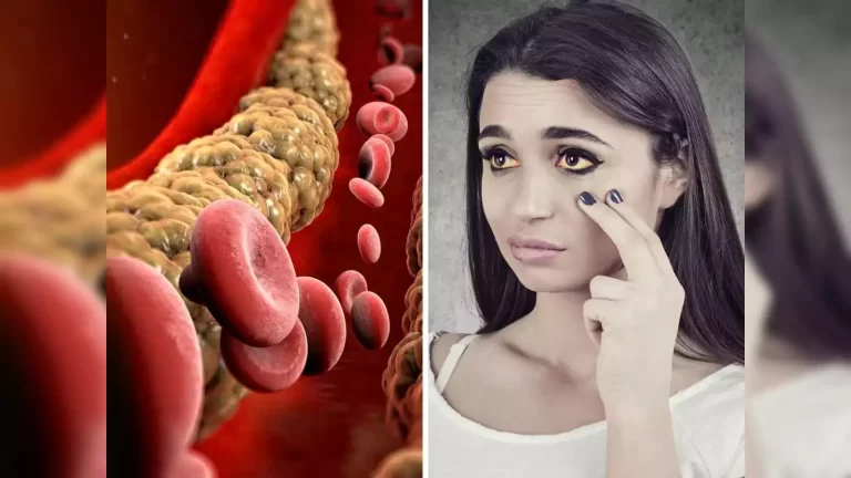 इन 6 लक्षणों से पहचानें बढ़ता कोलेस्ट्रॉल, तुरंत हो जाएं सतर्क