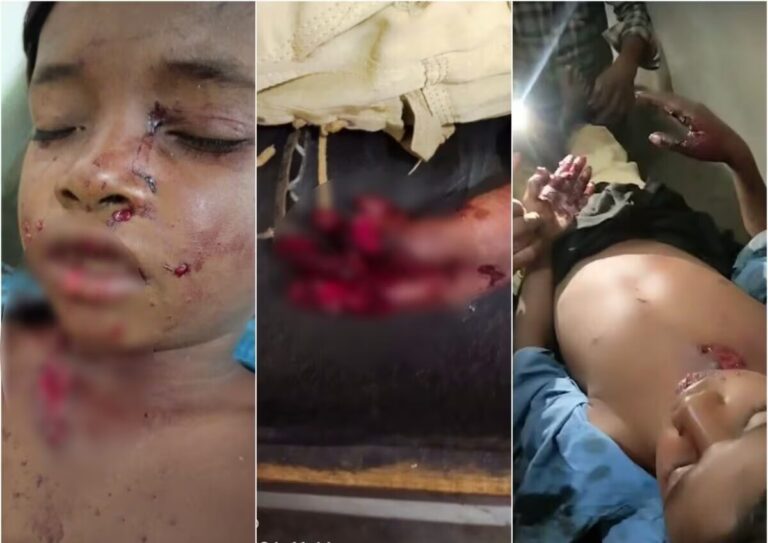 गेम खेलते वक्त मोबाइल फटने से बच्चा हुआ घायल