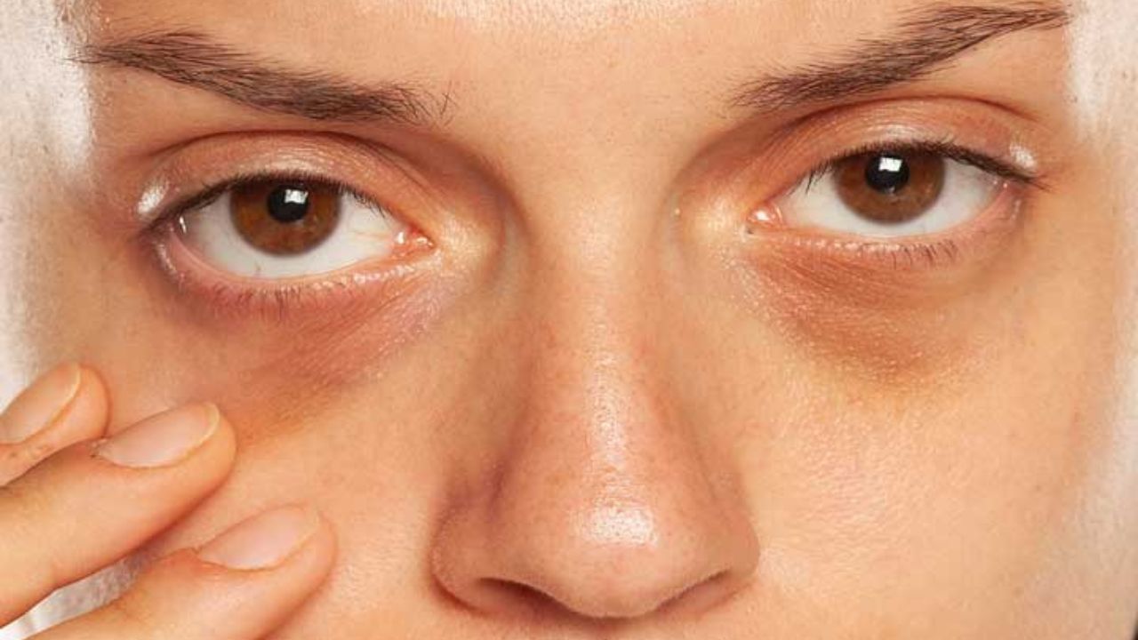 Dark circles: डार्क सर्कल्स का सच जानकर चौंक जाएंगे आप कुछ आदतें बनाती हैं चेहरा बूढ़ा और थका हुआ