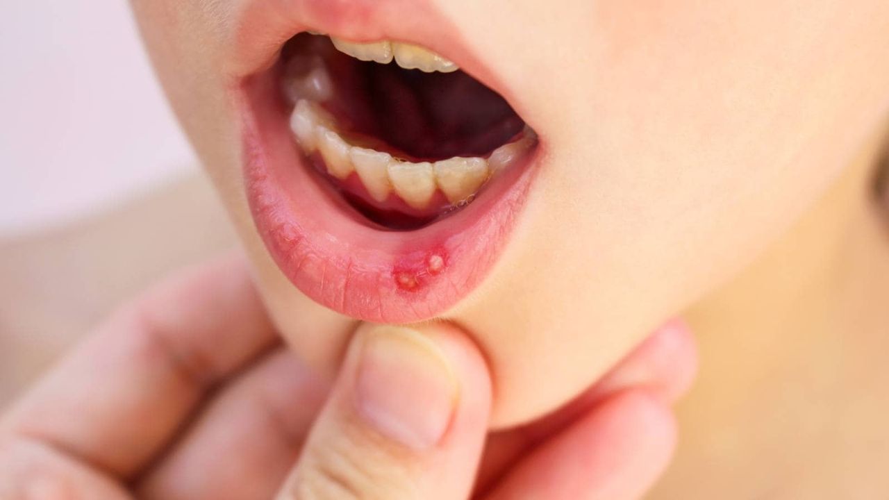 Mouth Ulcers: क्या मुंह के ये छाले हैं आपकी पेट की खराबी का इशारा? जानिए कैसे बिना दवा के पाएं राहत