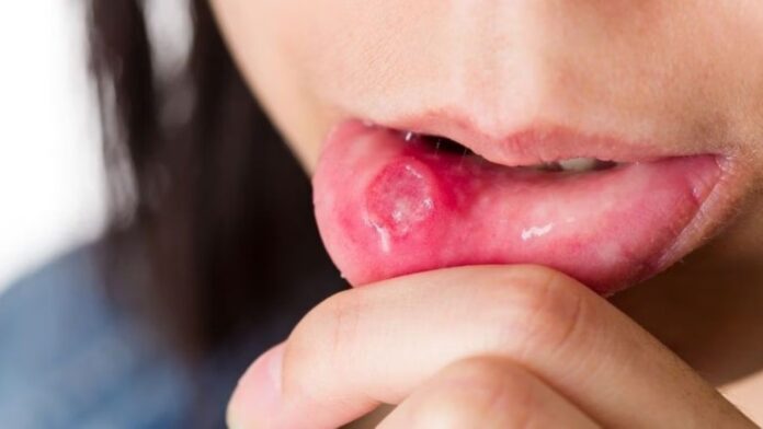 Mouth Ulcers: क्या मुंह के ये छाले हैं आपकी पेट की खराबी का इशारा? जानिए कैसे बिना दवा के पाएं राहत