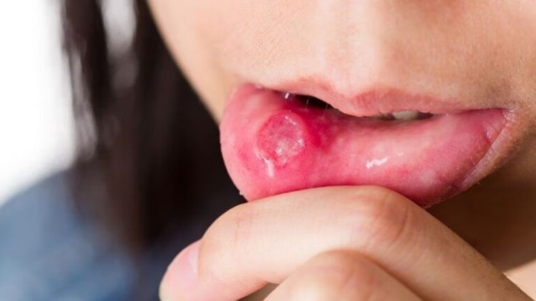 Mouth Ulcers: क्या मुंह के ये छाले हैं आपकी पेट की खराबी का इशारा? जानिए कैसे बिना दवा के पाएं राहत