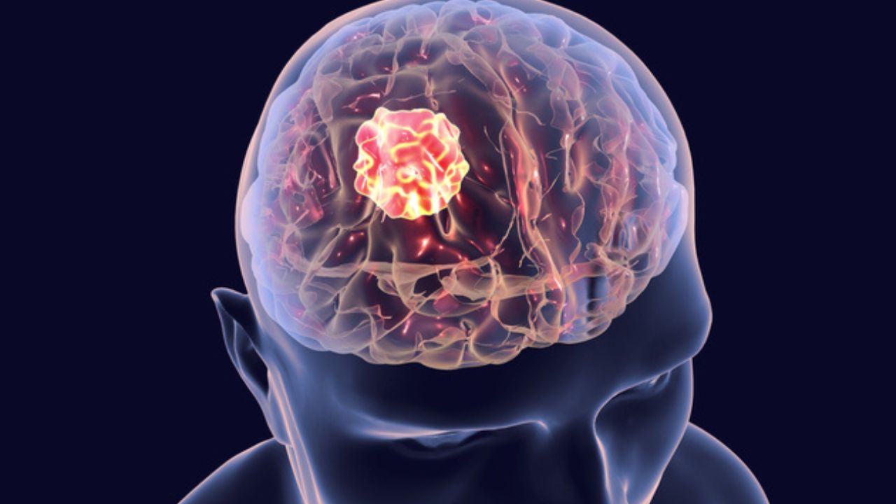 Brain Tumor: सुबह-सुबह का सिरदर्द बन सकता है जानलेवा खतरा जानिए ब्रेन ट्यूमर के छुपे संकेत
