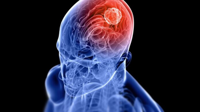 Brain Tumor: सुबह-सुबह का सिरदर्द बन सकता है जानलेवा खतरा जानिए ब्रेन ट्यूमर के छुपे संकेत