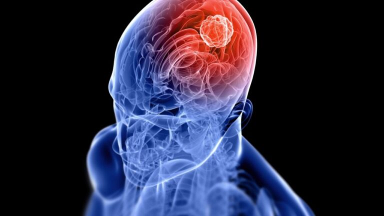 Brain Tumor: सुबह-सुबह का सिरदर्द बन सकता है जानलेवा खतरा जानिए ब्रेन ट्यूमर के छुपे संकेत