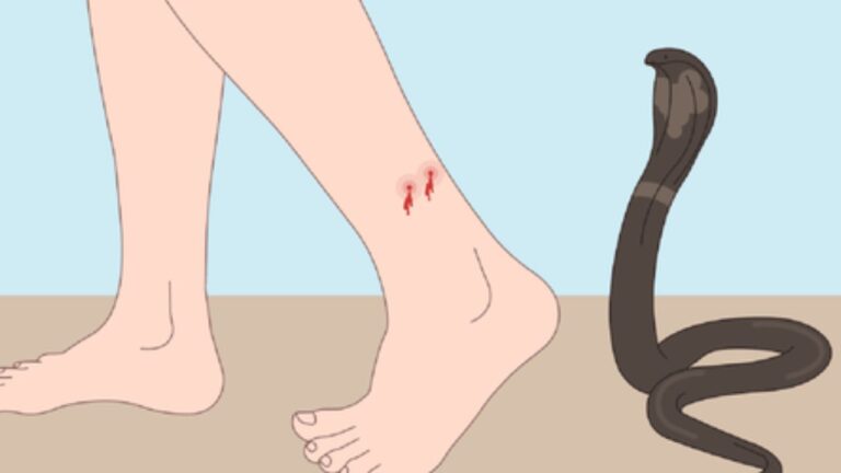 First Aid For Snake Bite: साँप के काटने पर क्या करें और क्या न करें! जानिए वो तरीका जो जहर को रोक सकता है