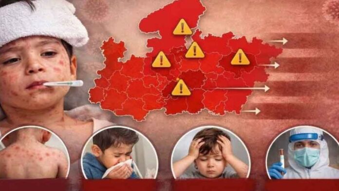 MP News: खसरे के अचानक बढ़ते केस, रतलाम में विभाग ने शुरू किया घर-घर टीकाकरण अभियान