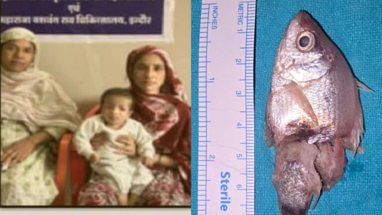 Indore News: इंदौर MYH अस्पताल में डॉक्टरों ने एक साल के बच्चे के गले से जिंदा मछली निकाली